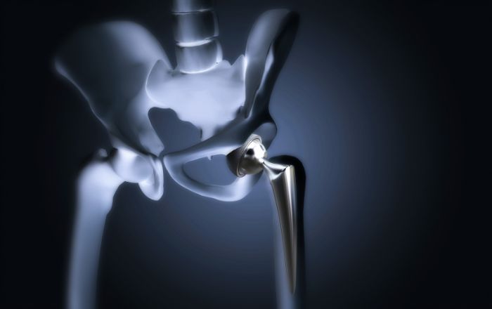 Hip Replacement